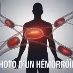 illustration vectorielle photo d un hémorroïde