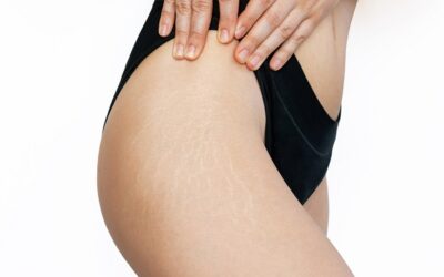 Smagliature: come prevenirle e quali opzioni di trattamento funzionano meglio