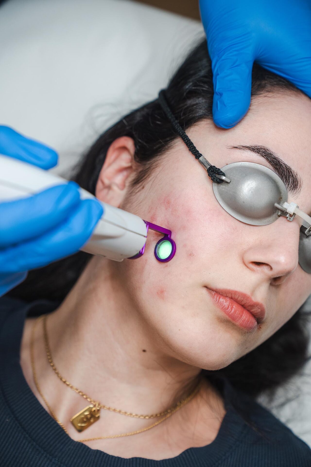 Trattamento laser per smagliature