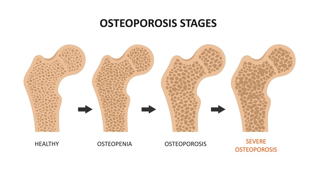 How can we reduce the risk of Osteoporosis?