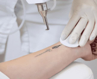 Refurbished Laser Tattoo Removal Machines