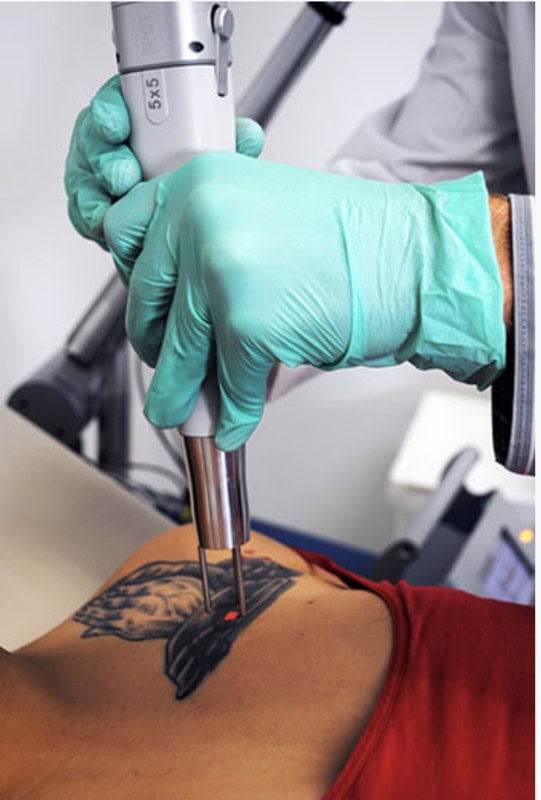 Tattoo Removal