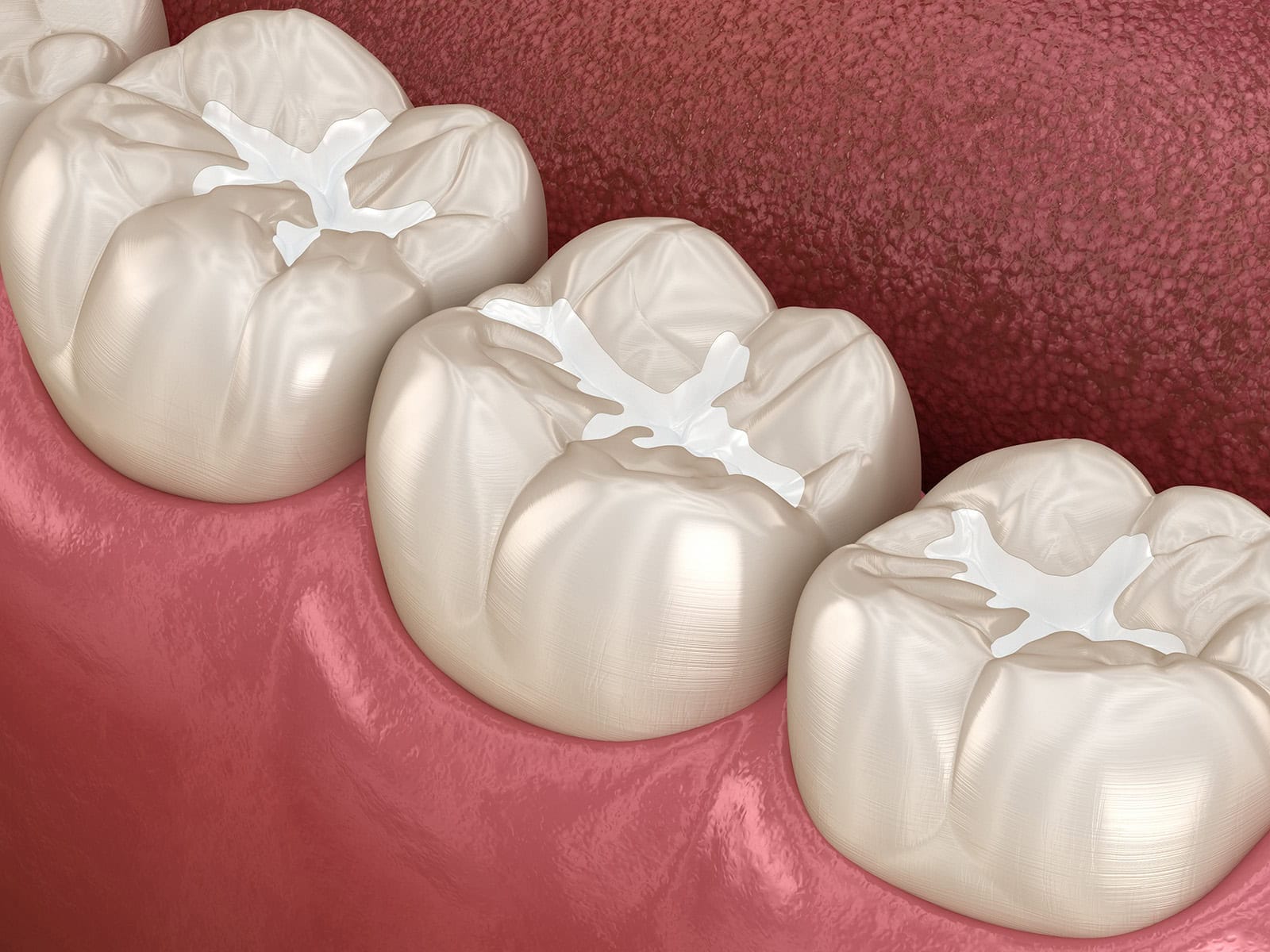 Composite fillings