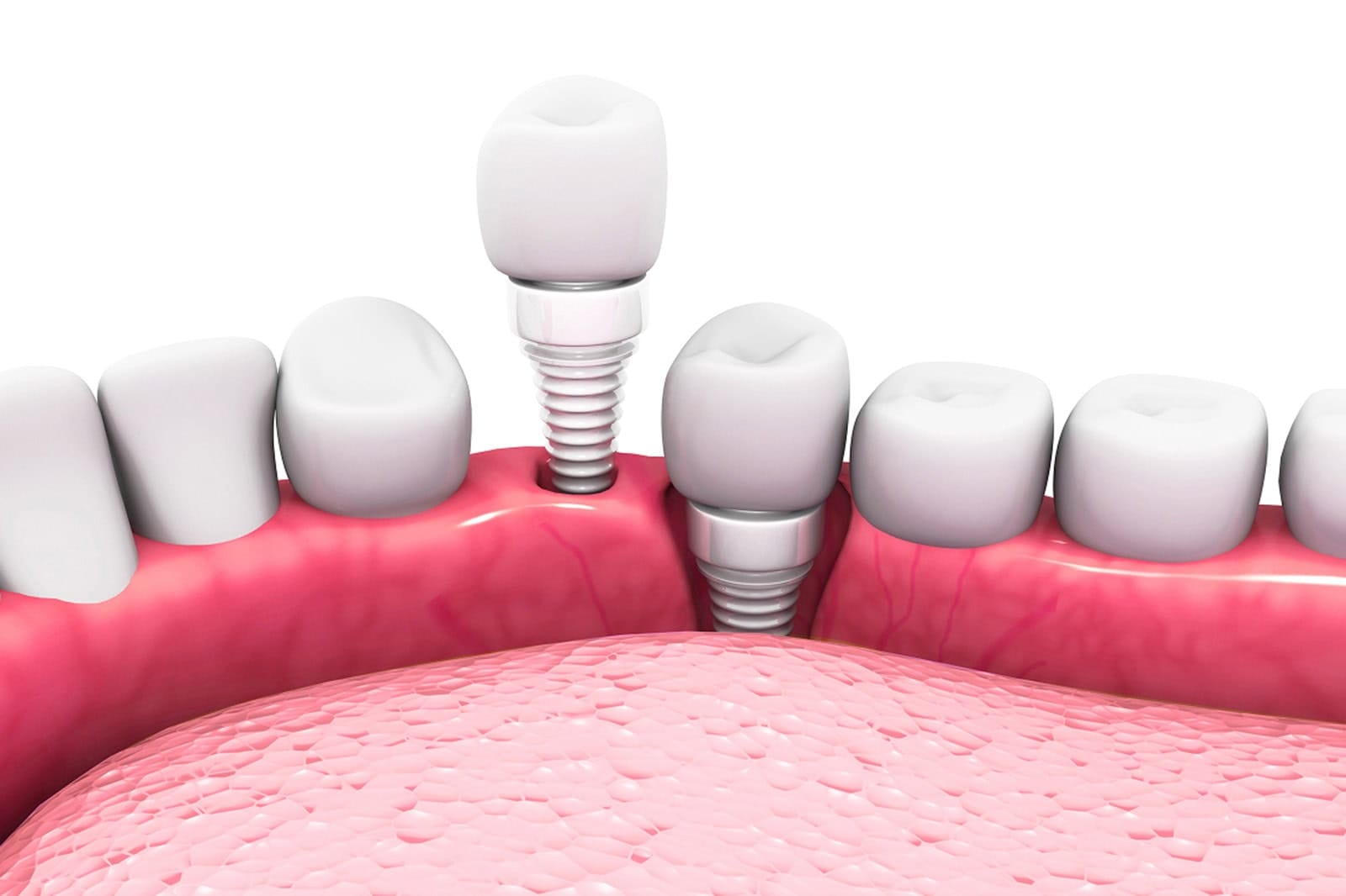 Dental implants