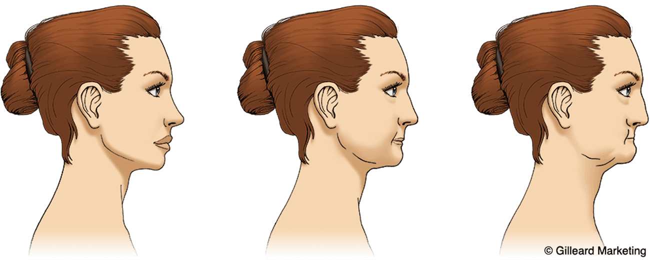 Jaw bone reduction diagram