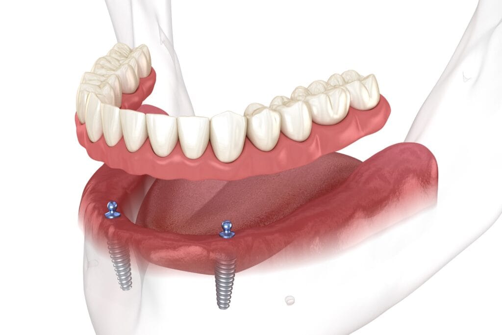 Snap-in dentures