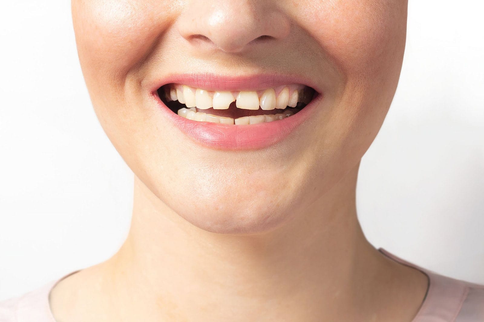 A woman with a chipped tooth