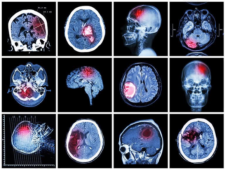 Brain Injury Tests, Procedures, and Outlook for TBI Patients