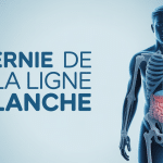 schéma hernie de la ligne blanche comment soigner sans operation