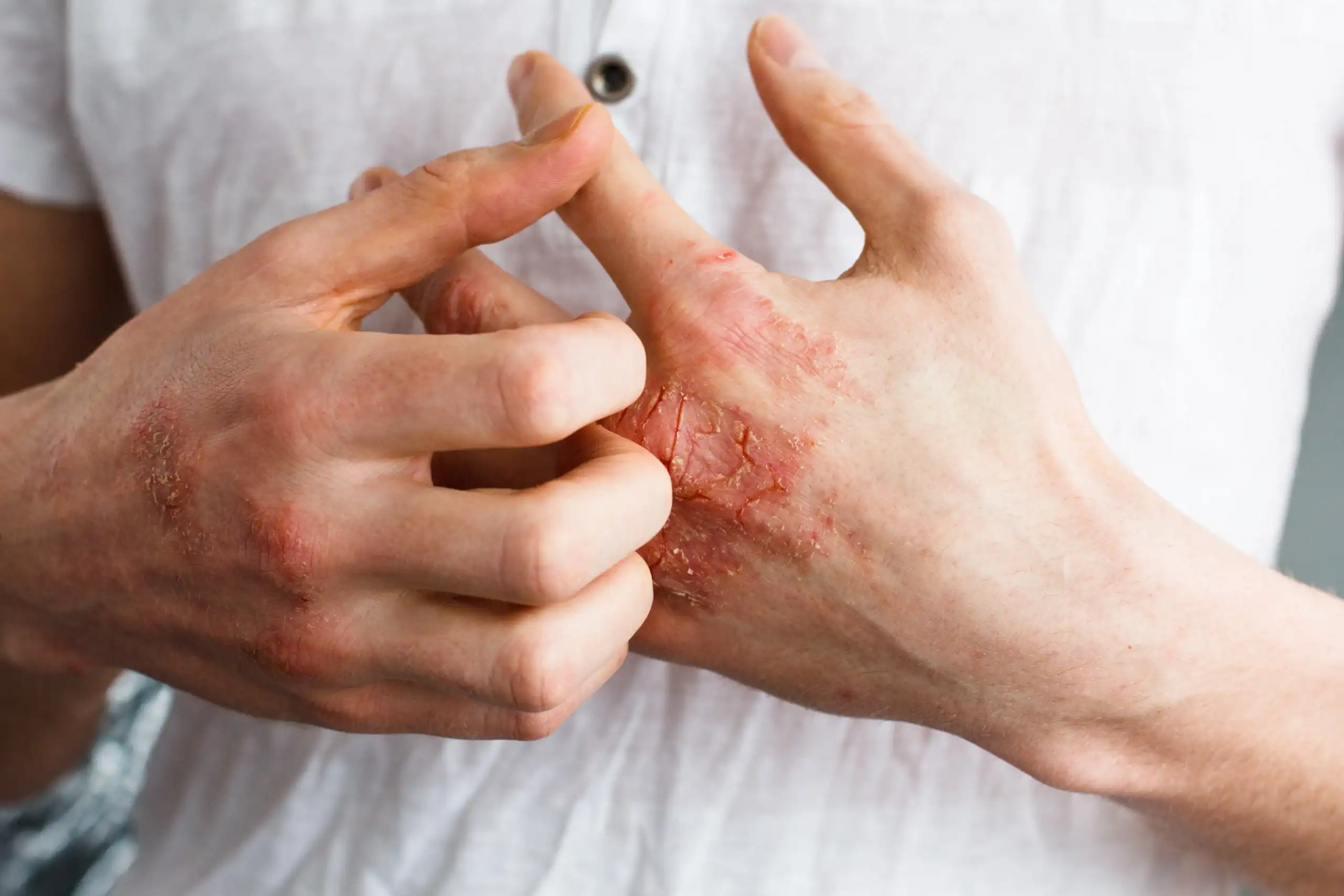 Man scratches hands with red eczema patches