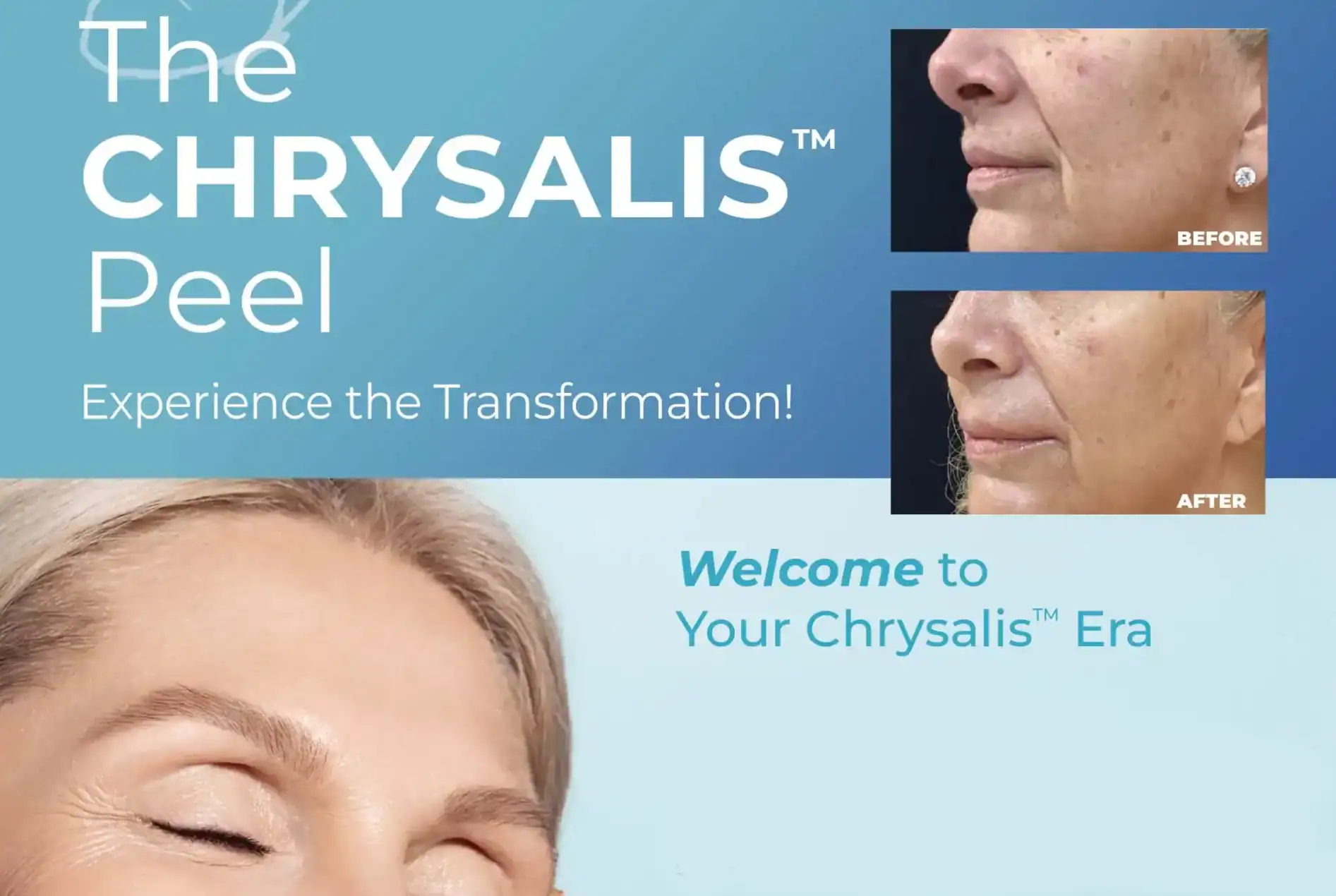 Horizontal version of Promotional flyer for Chrysalis treatment at Water's Edge