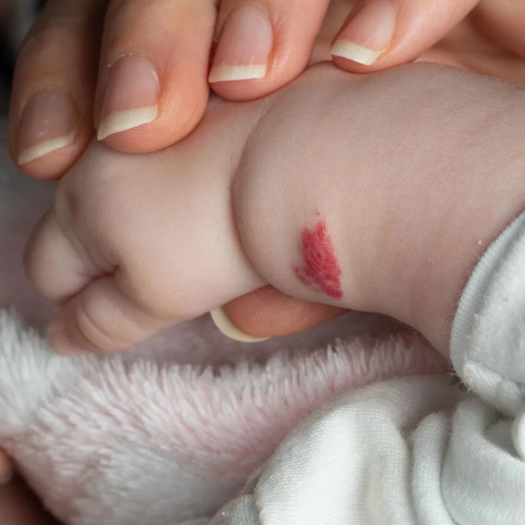Baby Skincare Stork Bites and Birthmarks