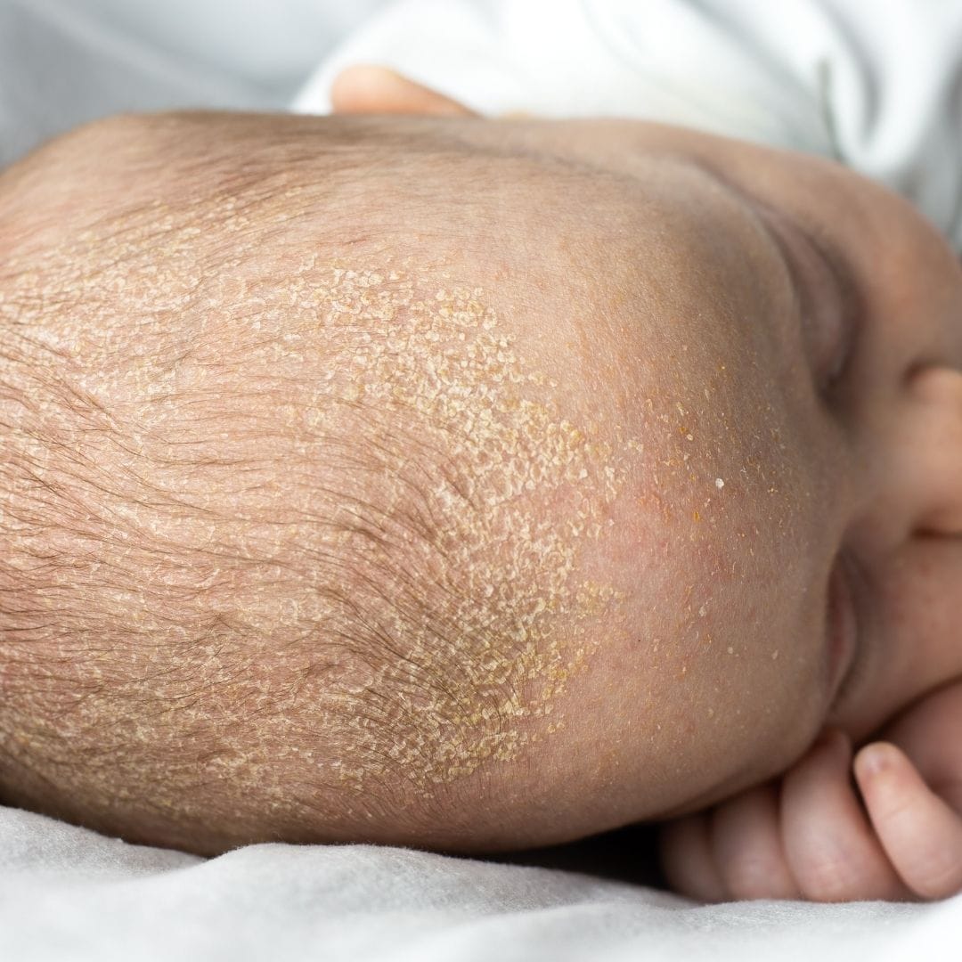 Cradle Cap Causes and Treatments-2