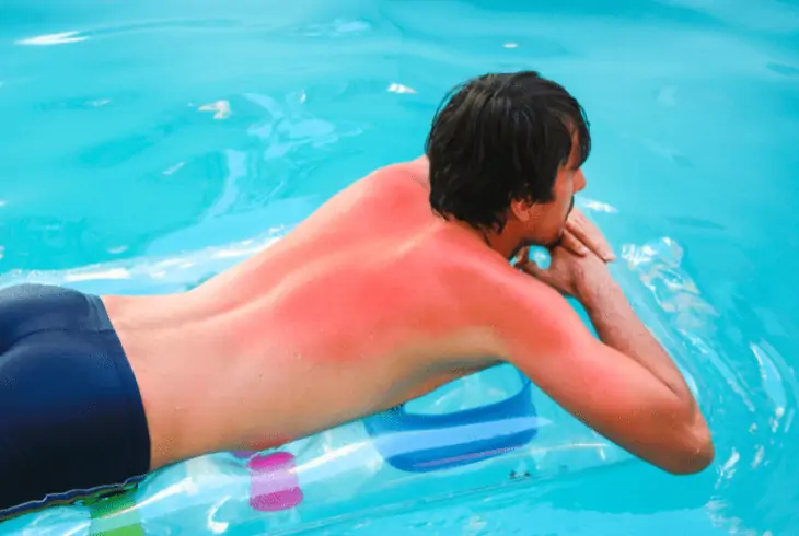 man with sunburn