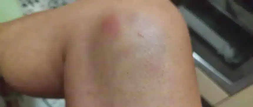 atropello