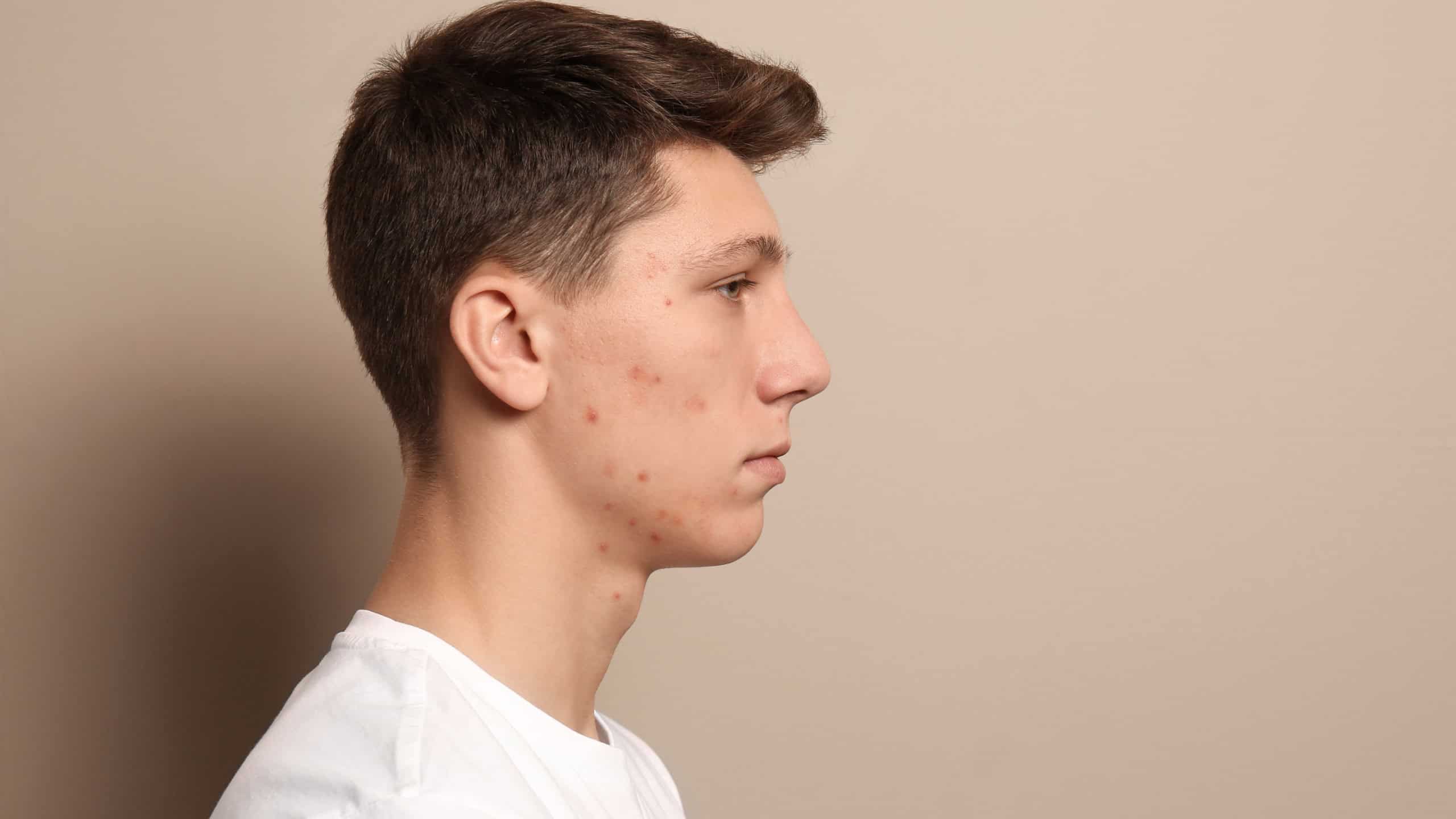 Teen guy with acne problem on beige background. Space for text