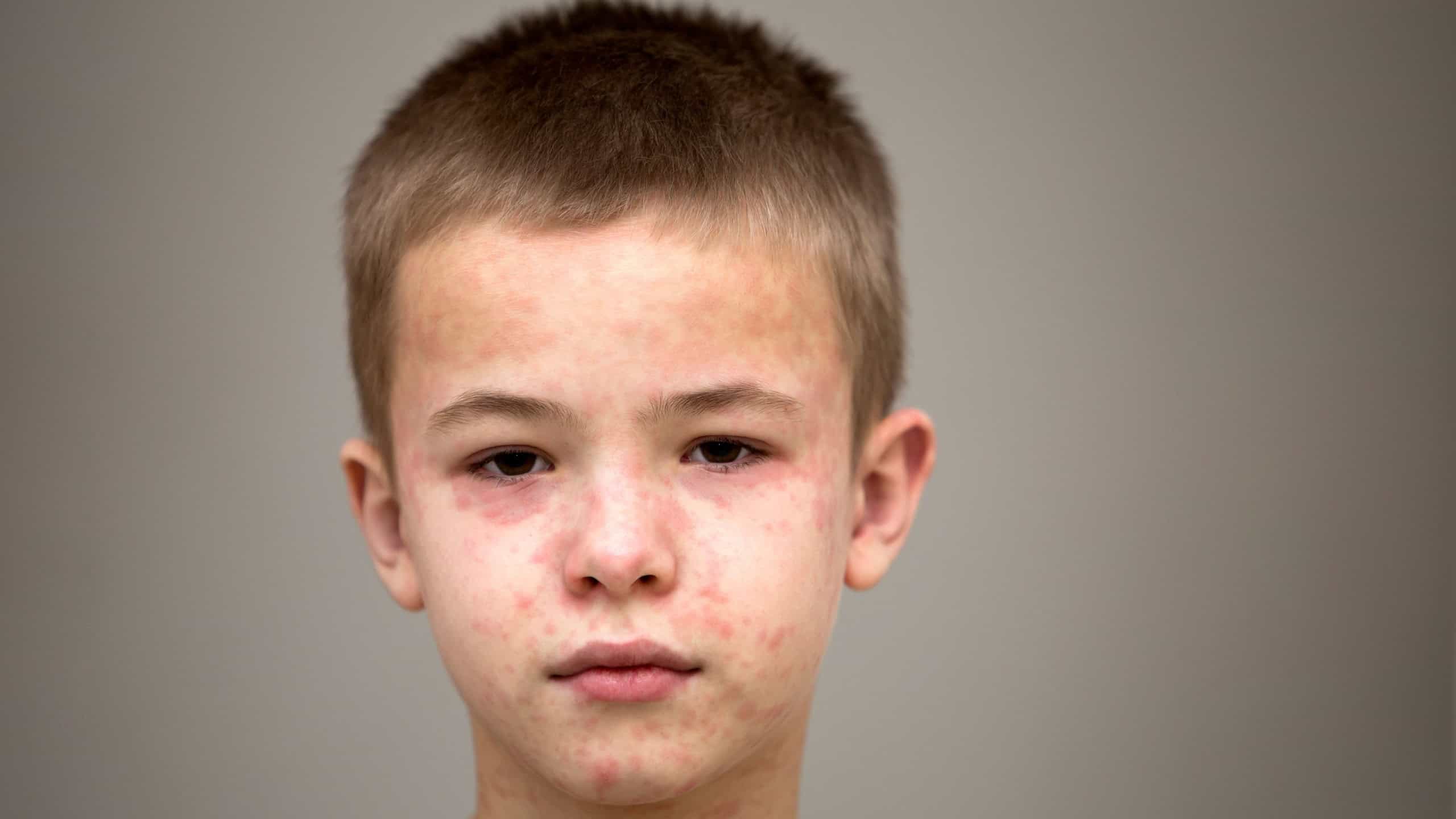 Portrait of sick sad boy child suffering from measles or chicken pox with bumps all over face. Contagious child diseases and treatment.