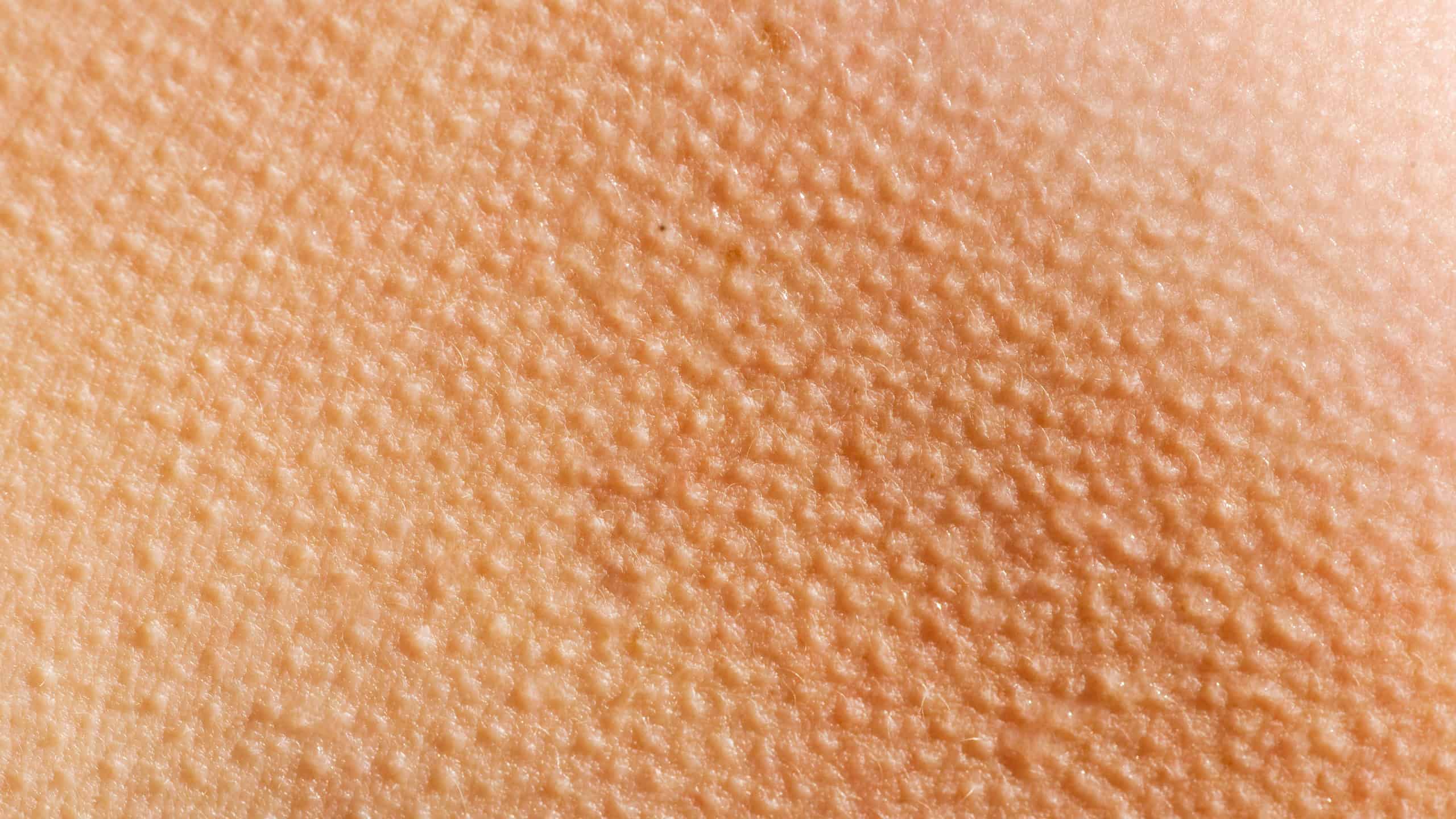 Human skin with goosebumps from the cold