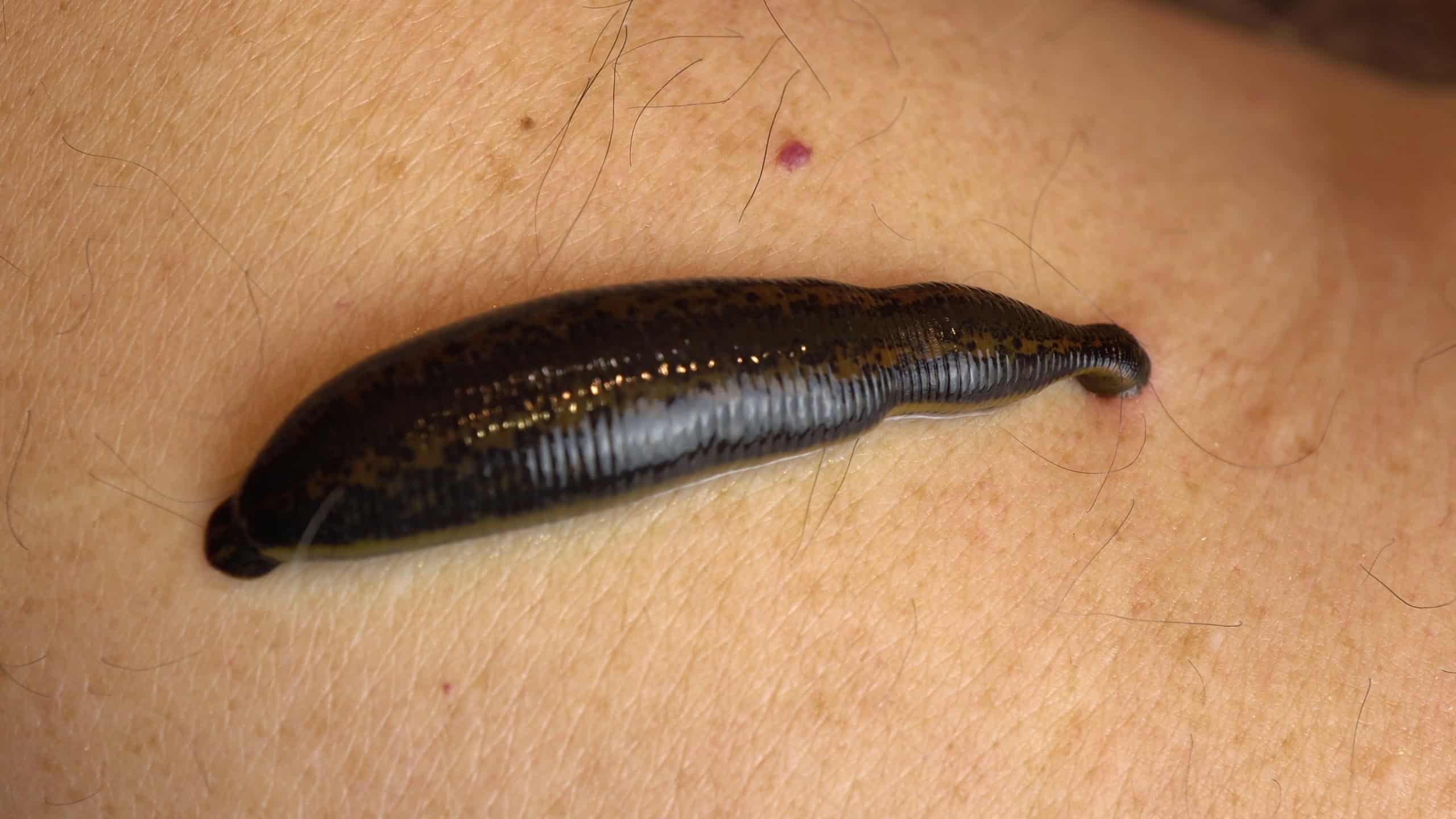 Medical leech on the human body drink blood. Treatment with leeches.
