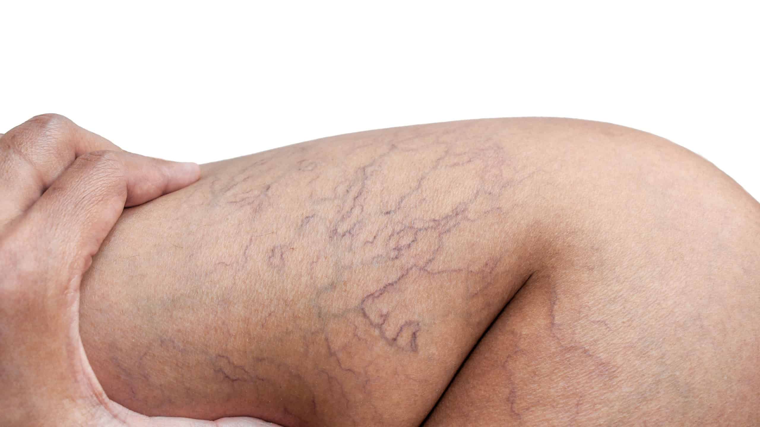 Varicose veins on the leg of a woman.