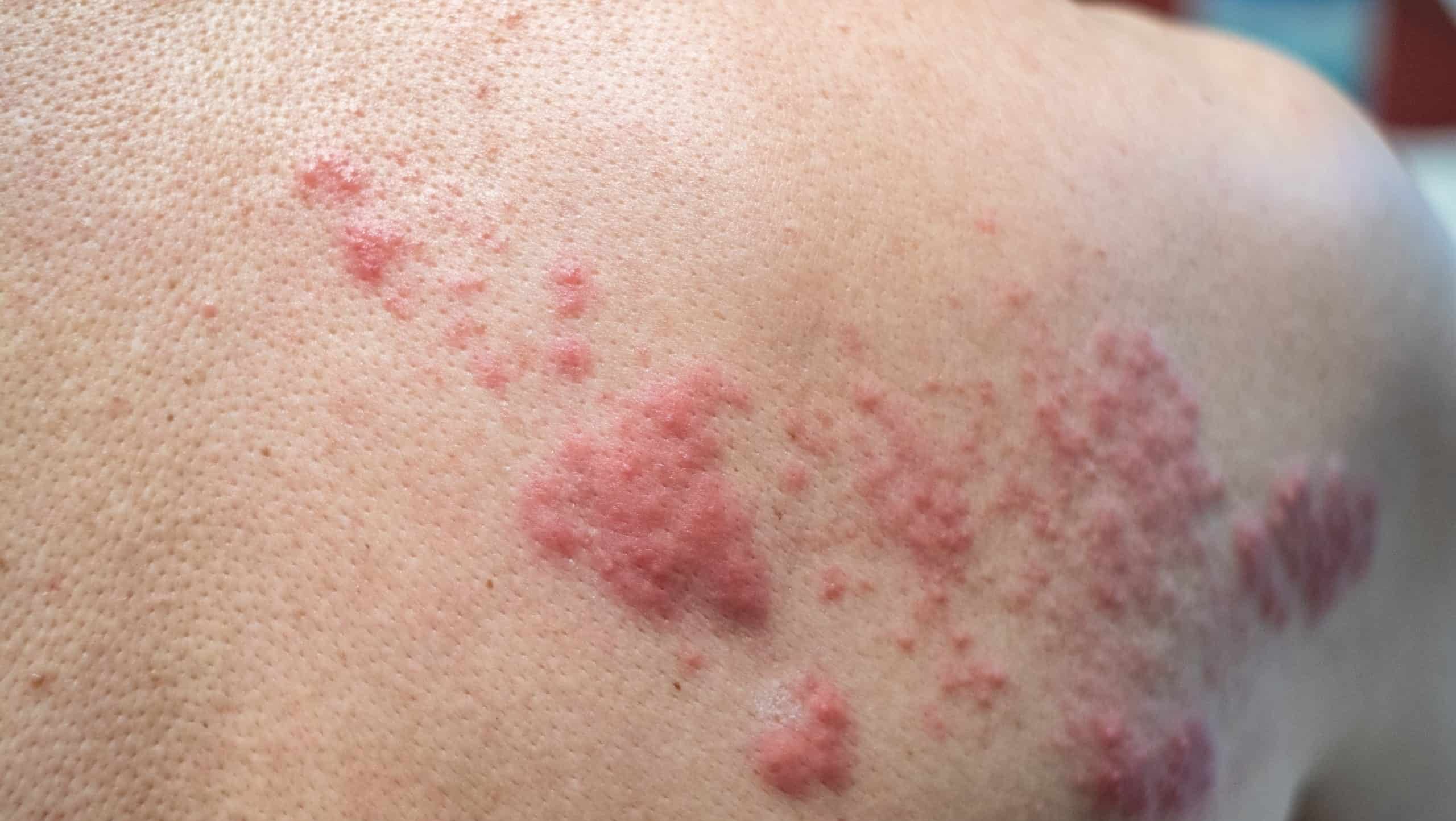 Shingles,(disease),,Herpes,Zoster,,Varicella-zoster,Virus.,Skin,Rash,And,Blisters
