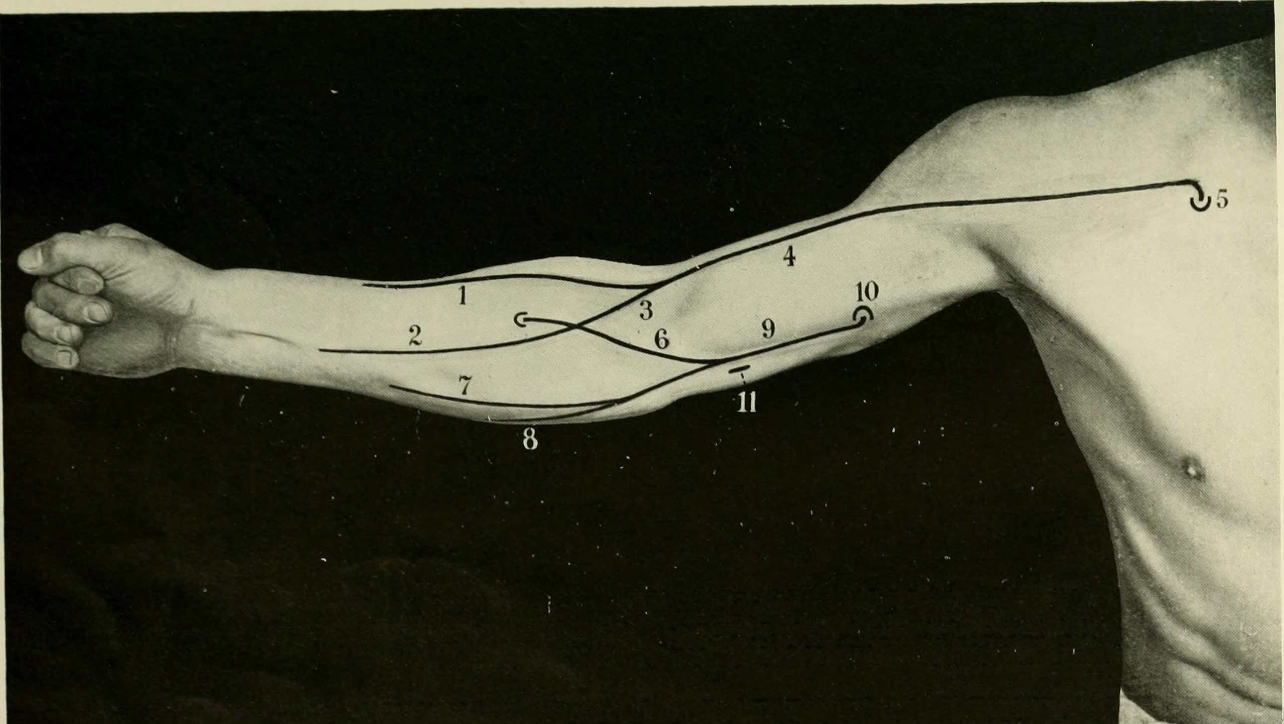 palmaris longus tendon