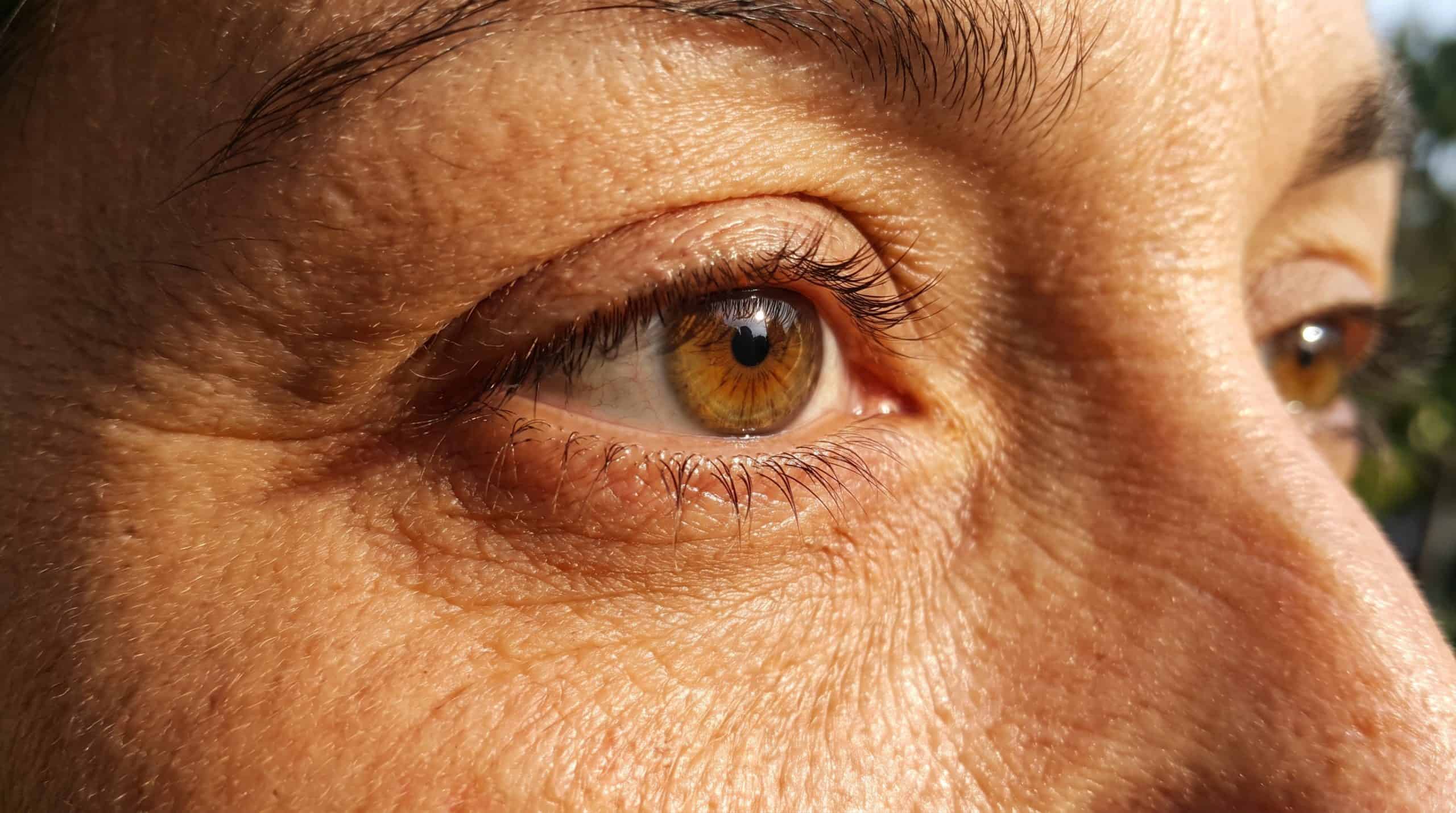 Distichiasis (a double row of eyelashes)