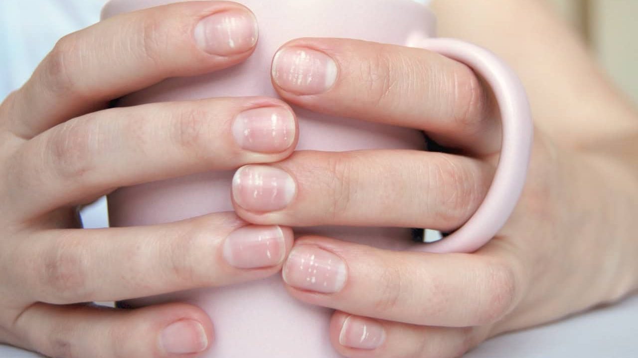 Many white spots on fingernails (Leukonychia) due to calcium deficit or stress. Female hands holding mug