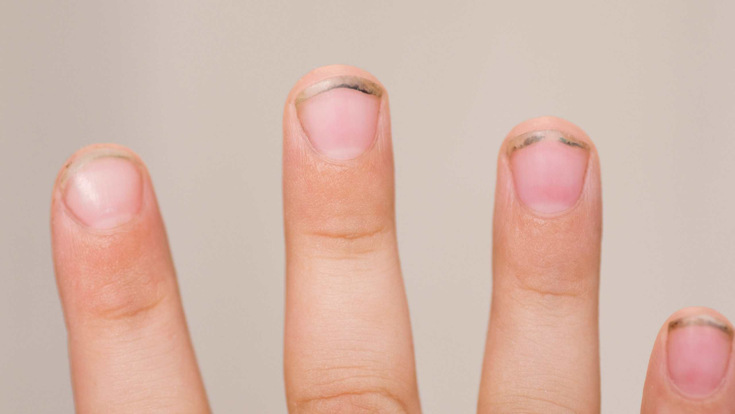 Dirty long nails have germs make sick. Dirt under the nails of a child. Hygiene children's hands