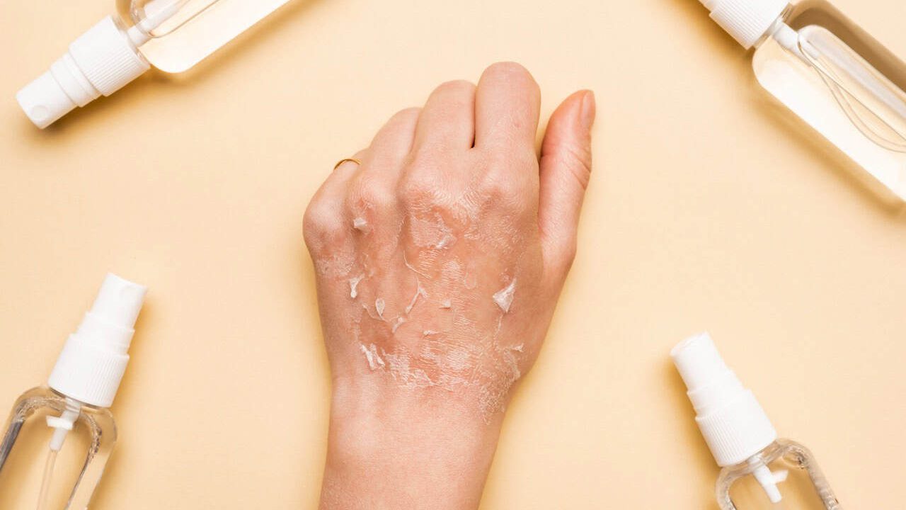 cropped view of female hand with dry, exfoliated skin near spray bottles with antiseptic on beige