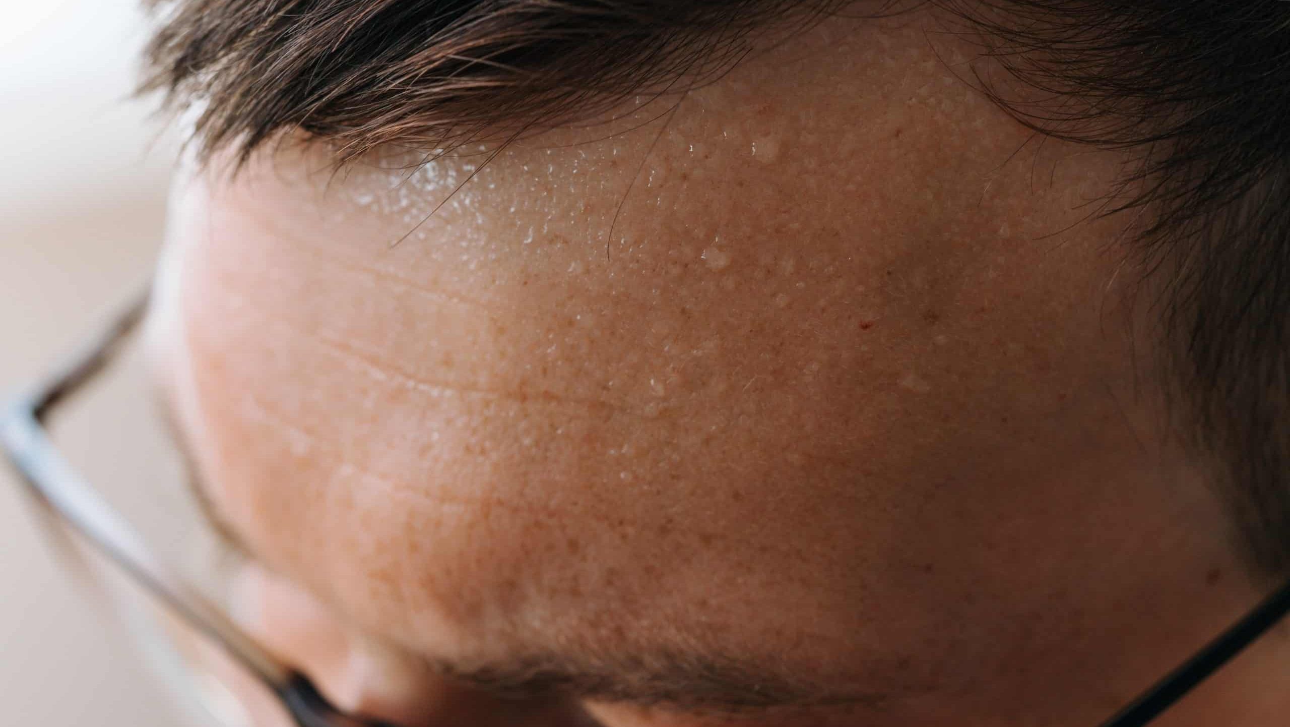 Close-up man sweaty forehead, highlighting skin texture and moisture, with part of his glasses visible. Stressful work in stuffy office, employee does not have time to finish entire amount of work