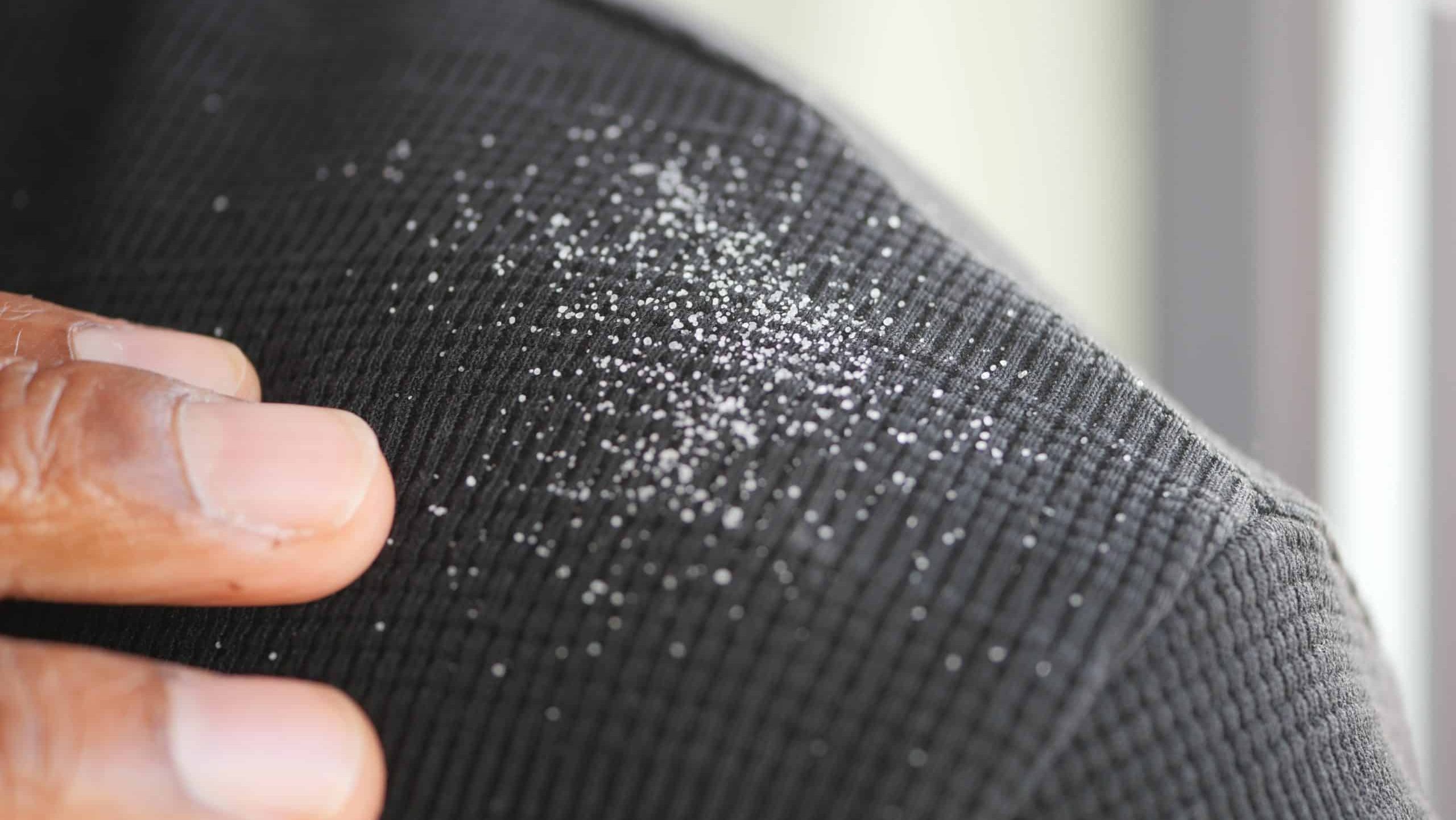 Dandruff on dark fabric near a person's shoulder