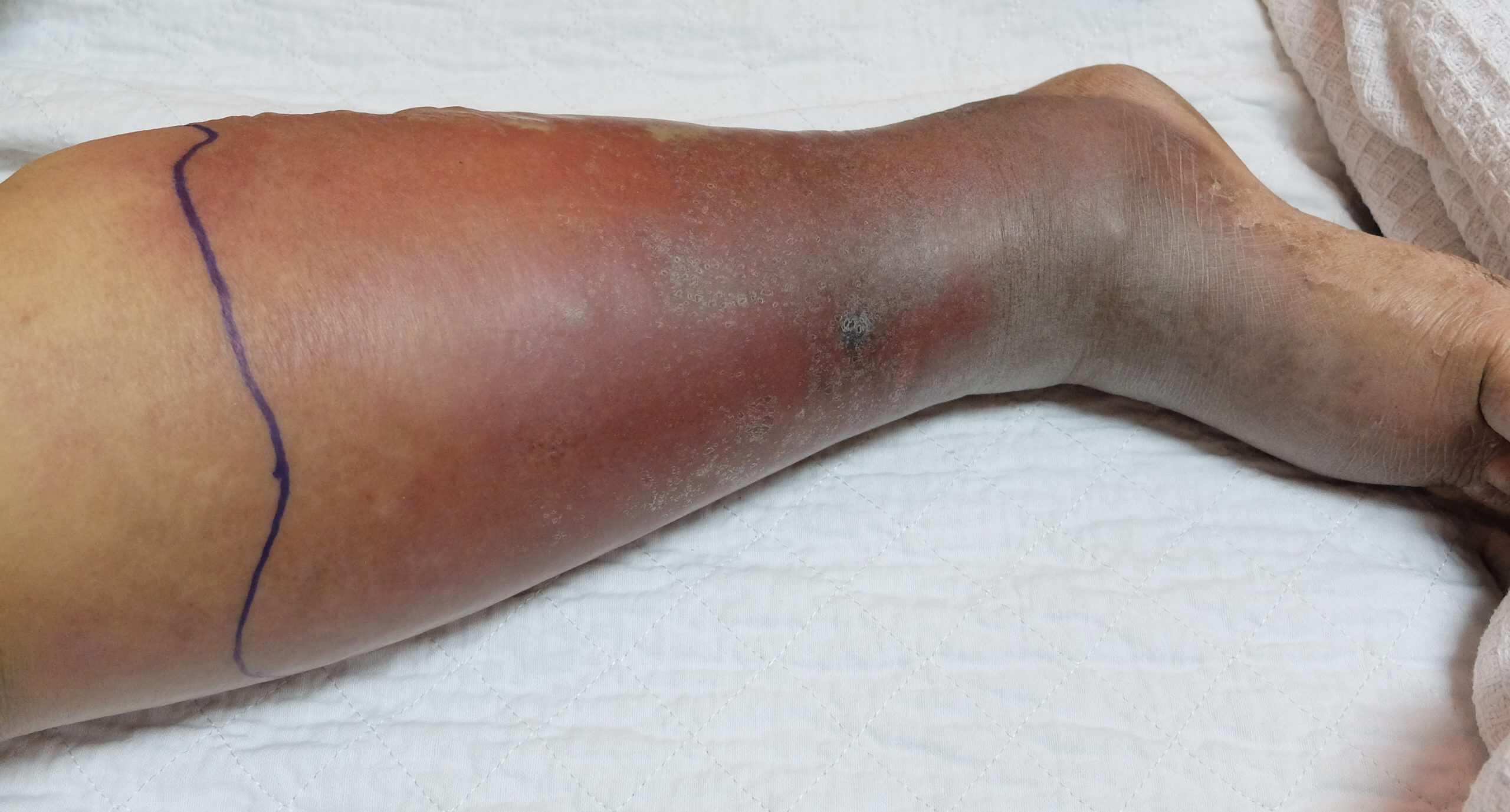 Lower,Limb,Cellulitis,And,Deep,Vein,Thrombosis.