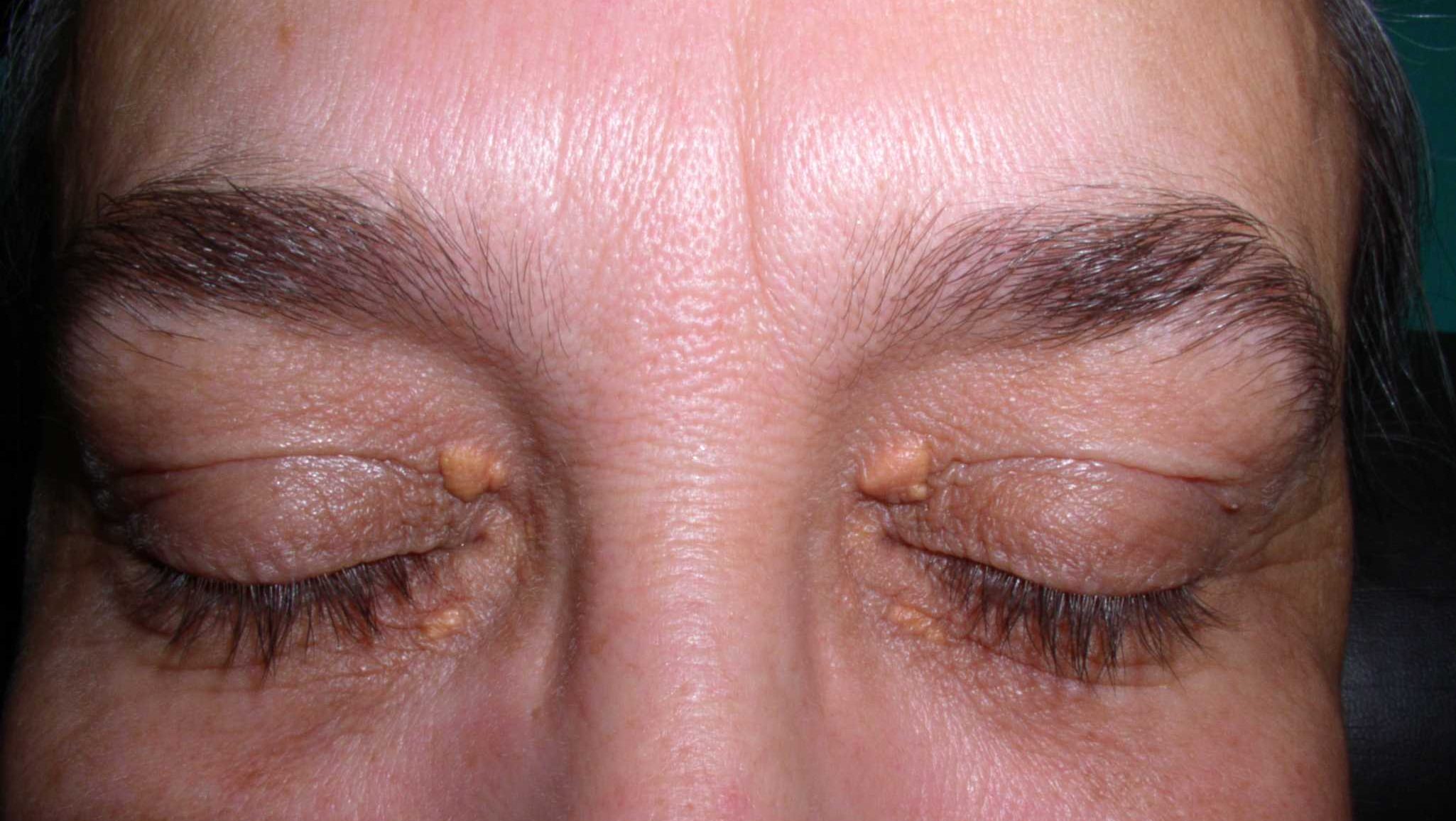 xanthelasma