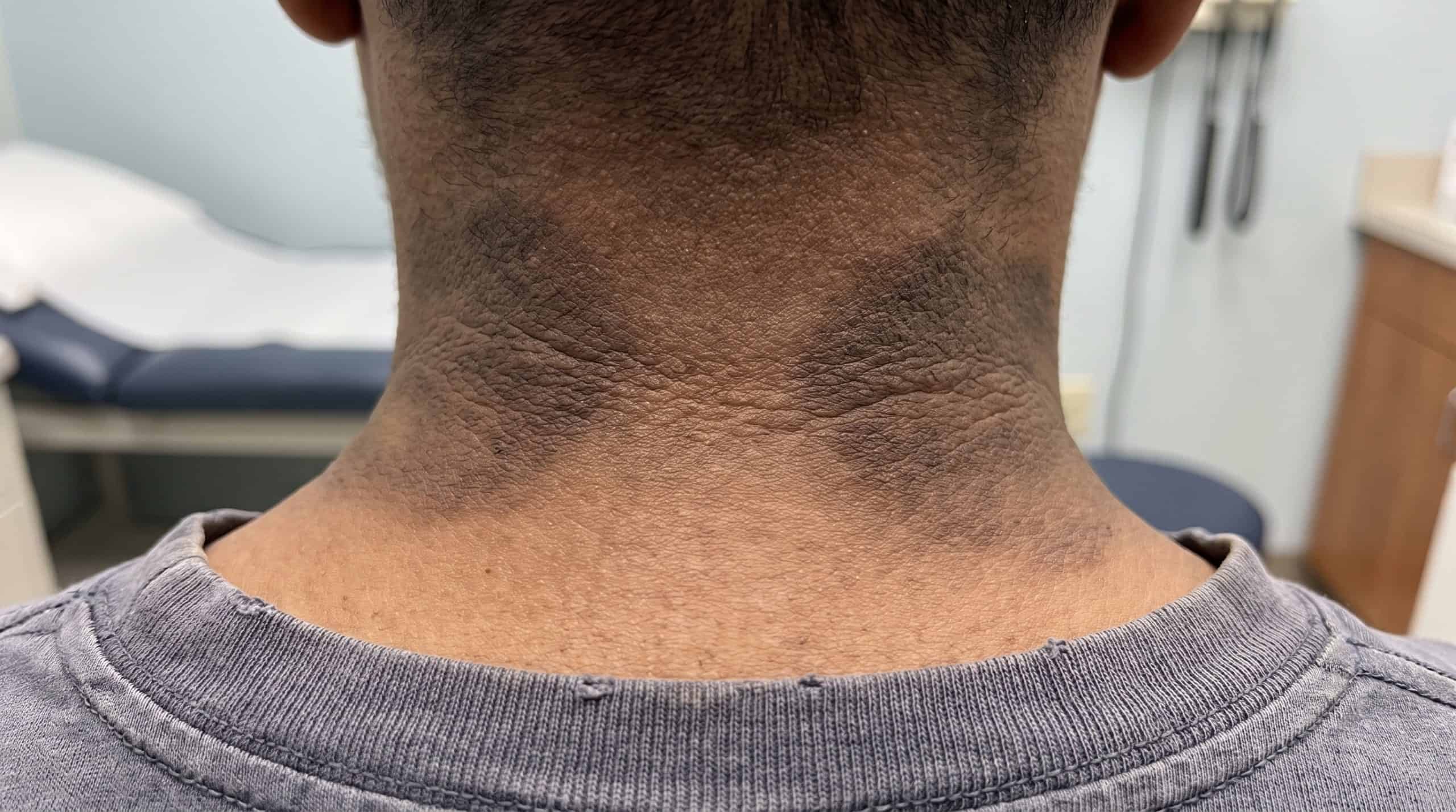 acanthosis nigricans