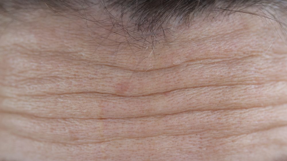 Facial wrinkles on forehead of adult woman closeup. Aesthetic medicine concept
