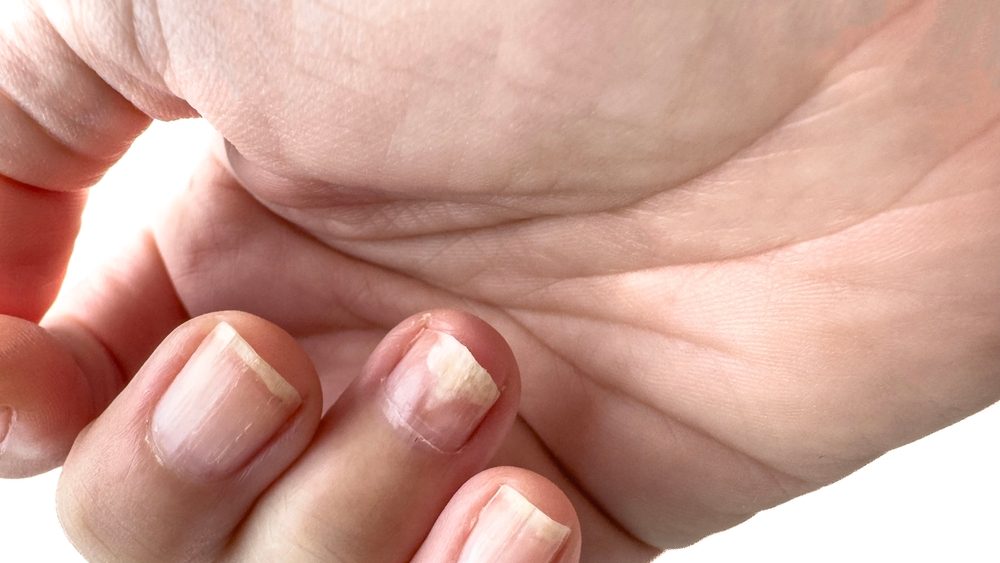 closeup female hand with Damaged Fingernail Showing Peeling and Weak Nail. unhealthy nail texture and breakage, isolated on white, nail health issue or deficiency.damaged nail separates from flesh