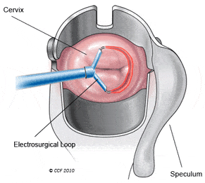 loop-electrosurgical Loop Electrosurgical Excision Procedure (LEEP) Healing from Leep.