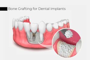 bone2Bgrafting