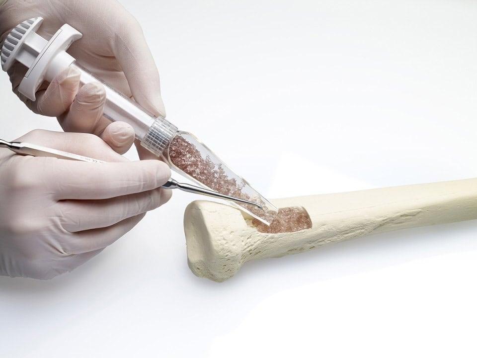 Bone Grafts and Substitutes Market1