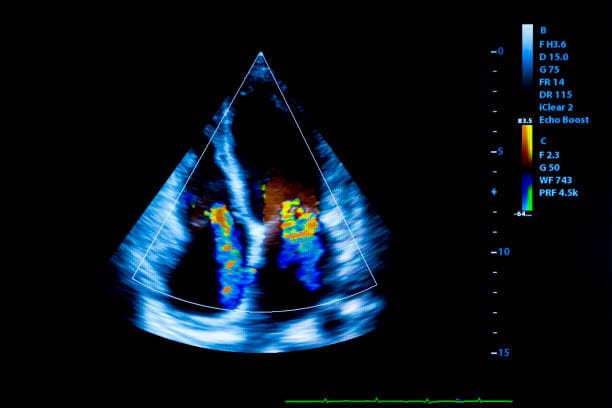 Echocardiography