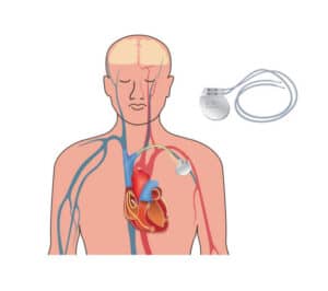 Implantable Drug Device Market