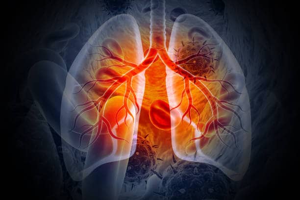 Lung Cancer Diagnostic Test