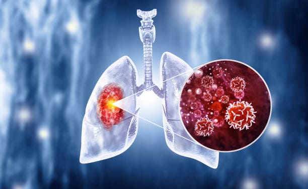 Lung Cancer Market