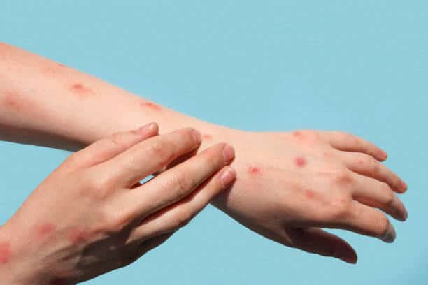 Monkeypox Disease Diagnostics Market