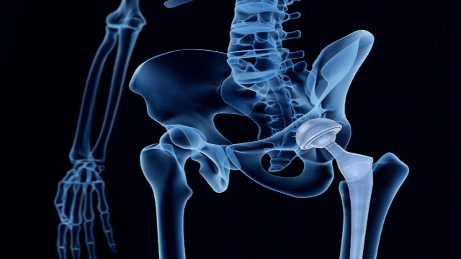 Orthopedic Implants Market3