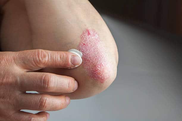 Psoriasis Drugs