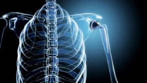 Spinal Implant Market