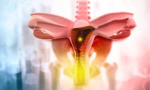 Uterine Fibroid Treatment Devices