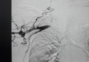 Iliac Stent